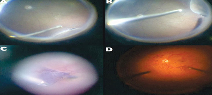 Viteoretinal Surgeries